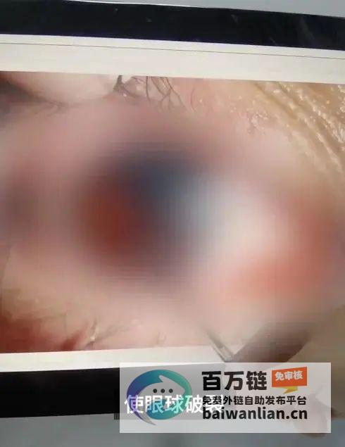 小心过冬神器男孩摇晃后此前有人不慎致眼球